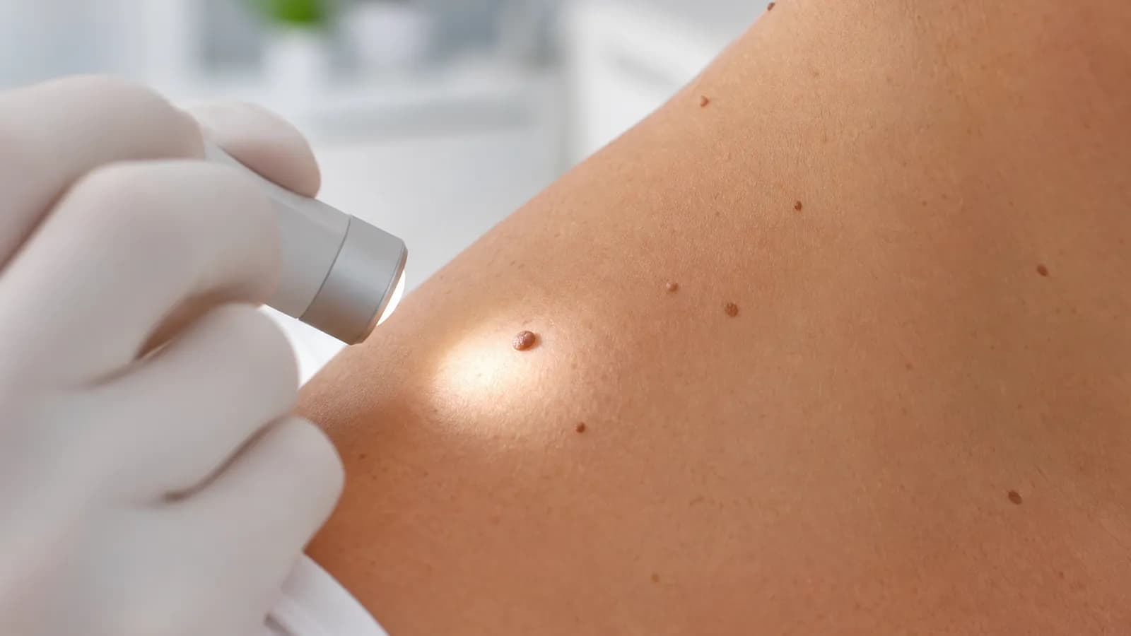 Dermatoscope examination of a skin growth