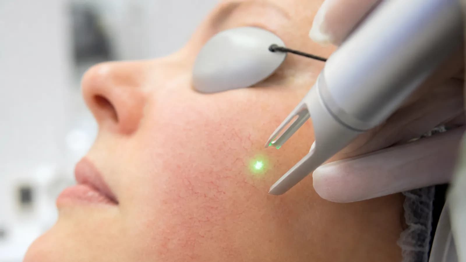 KTP laser treatment targeting facial vascular lesions