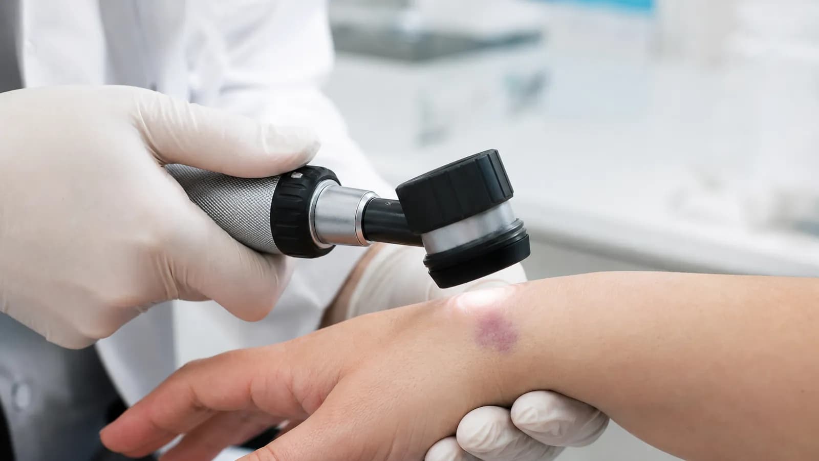 Close dermatologic examination of skin affected by lichen planus