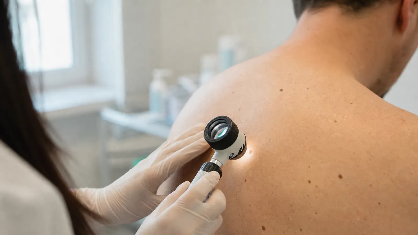 Dermatologist examining a mole with a dermatoscope before removal