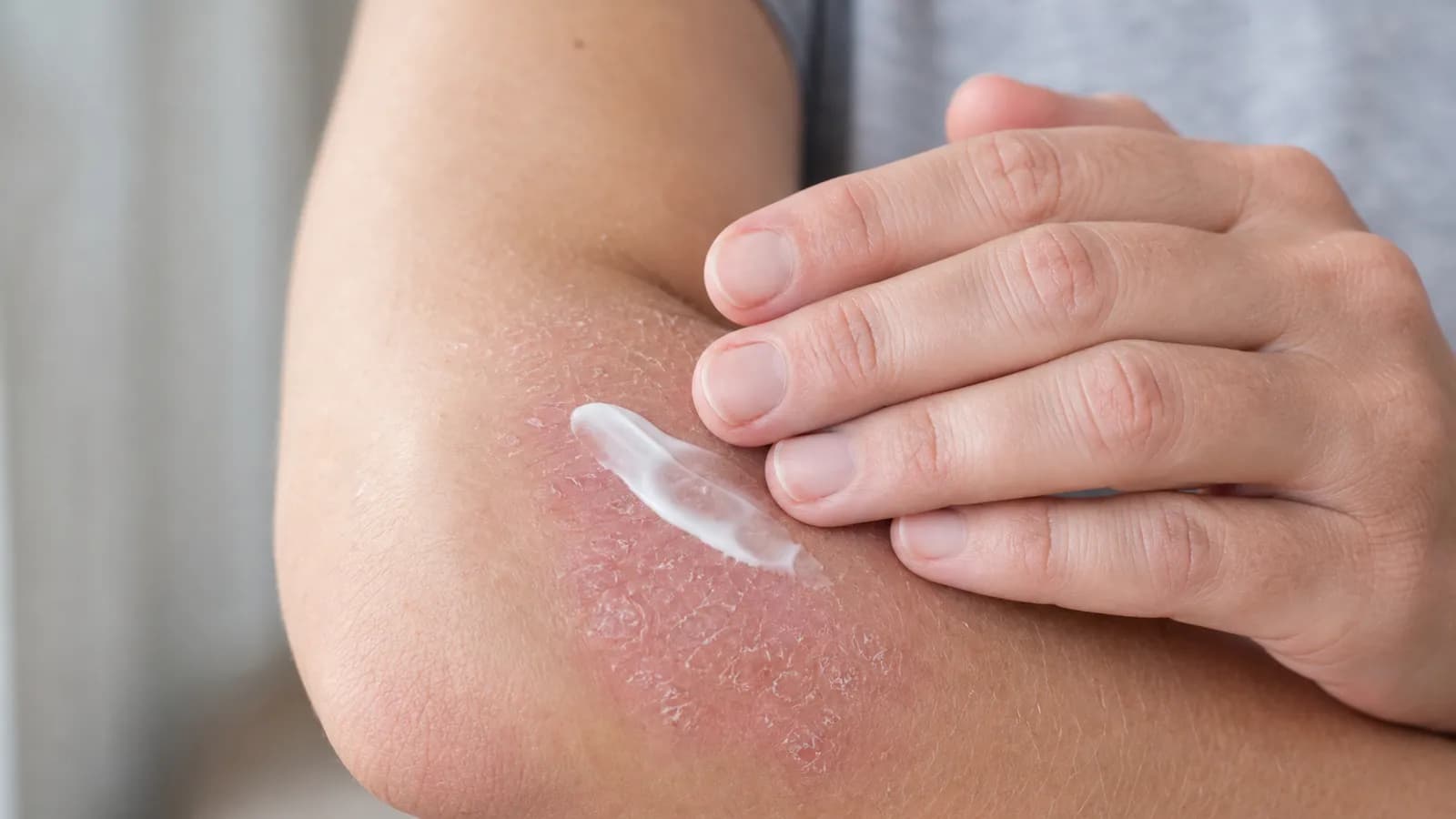 Dermatologist examining psoriasis plaques on a patient’s arm