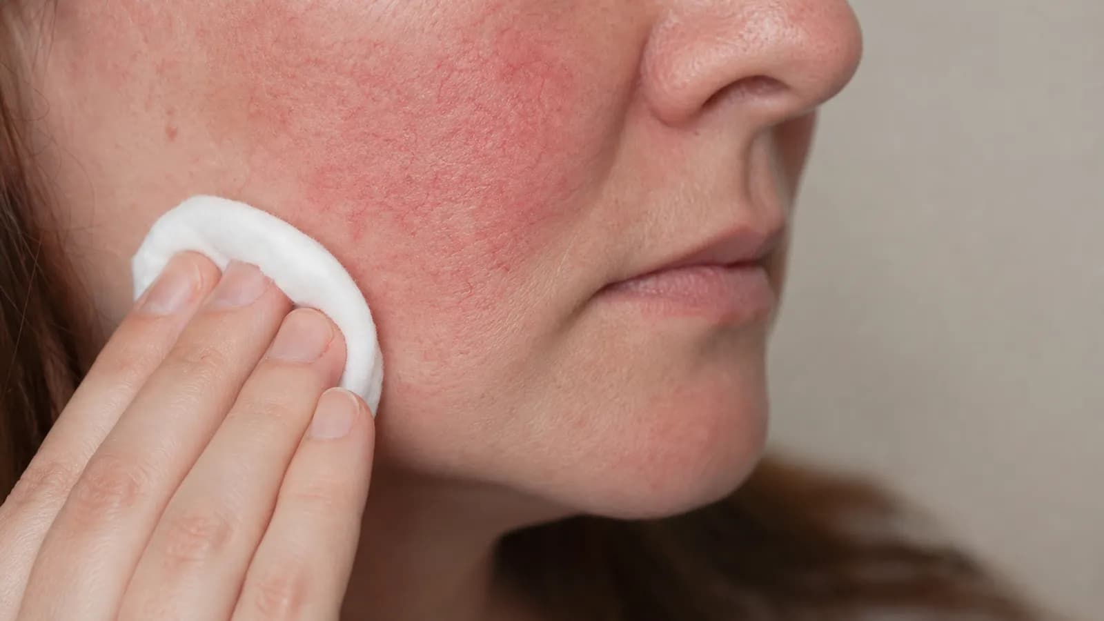 Gentle skincare treatment for rosacea-prone facial redness
