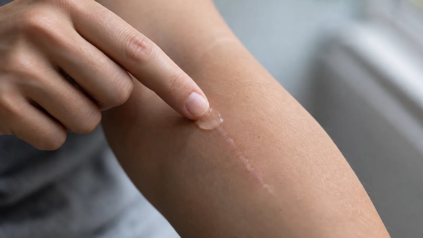Scar revision treatment on a patient’s skin
