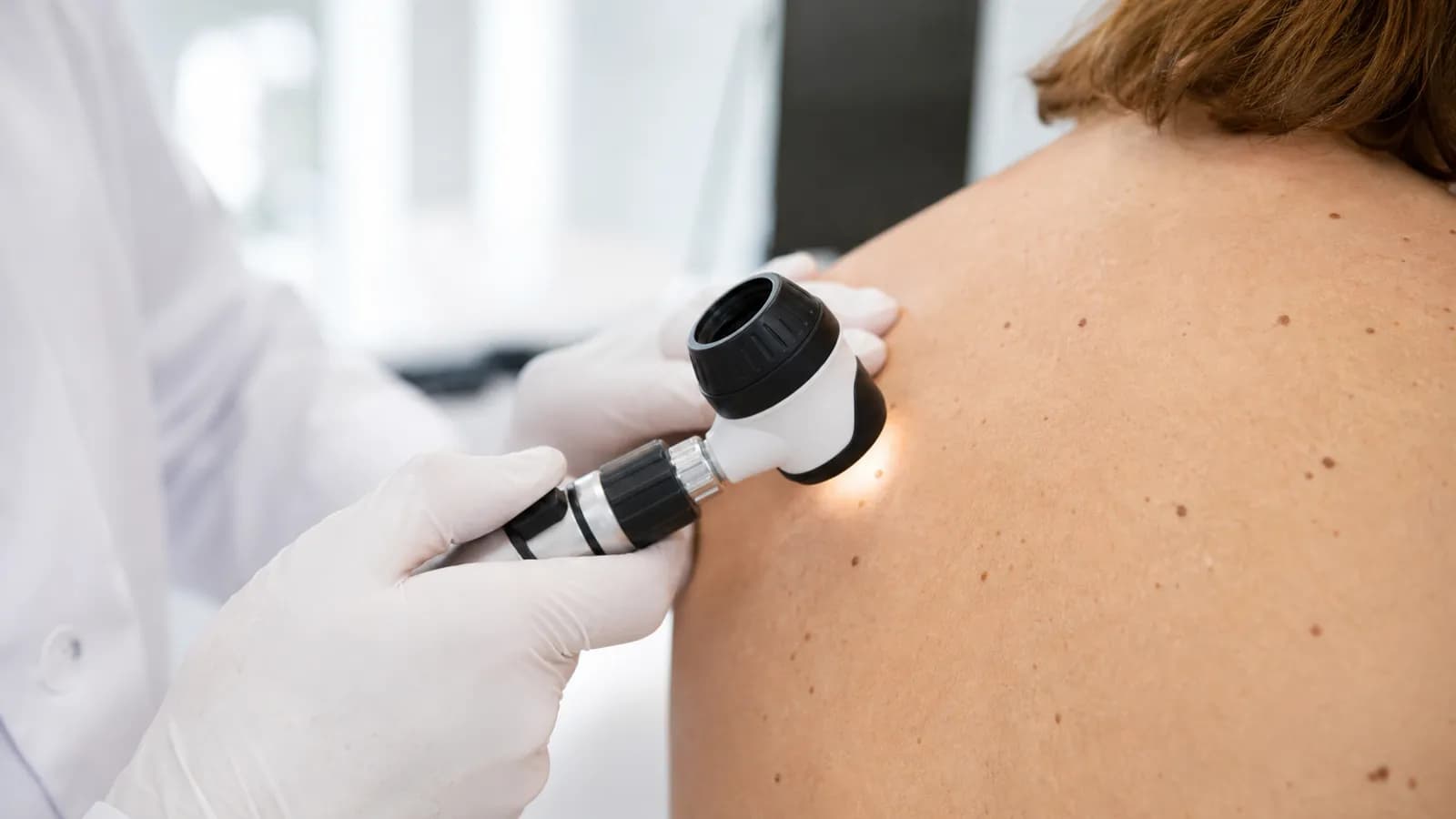 Dermatologist performing a skin cancer screening with a dermatoscope