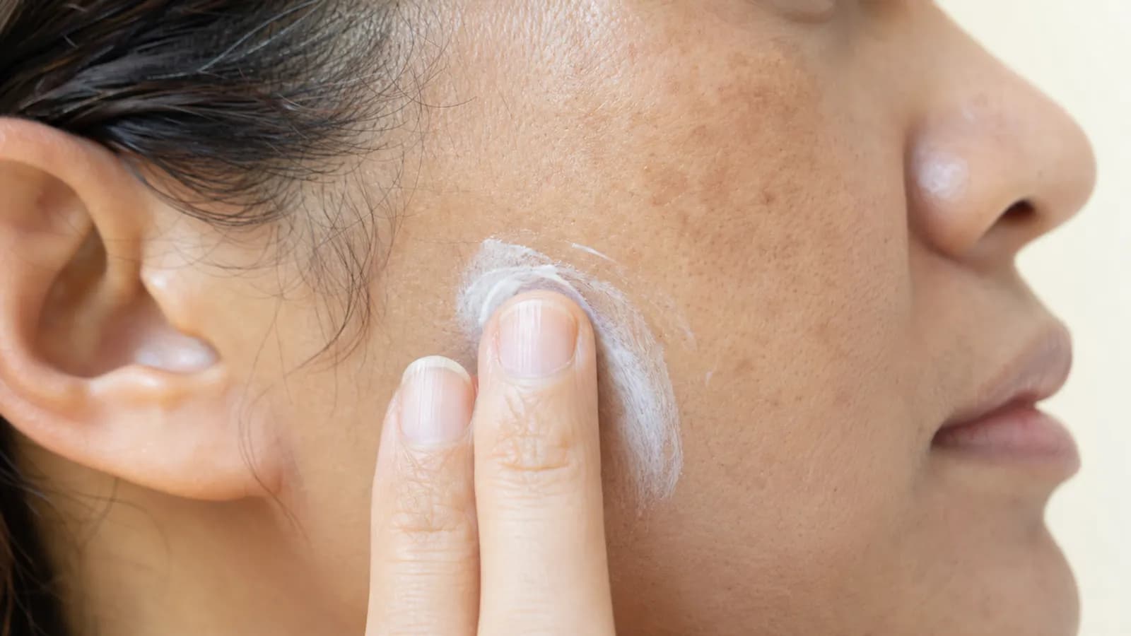 Dermatologist assessing areas of skin discoloration