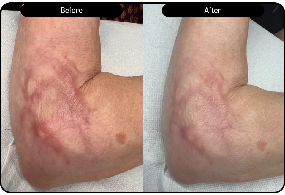 Elbow scarring reduction after 2 Multifrax treatments