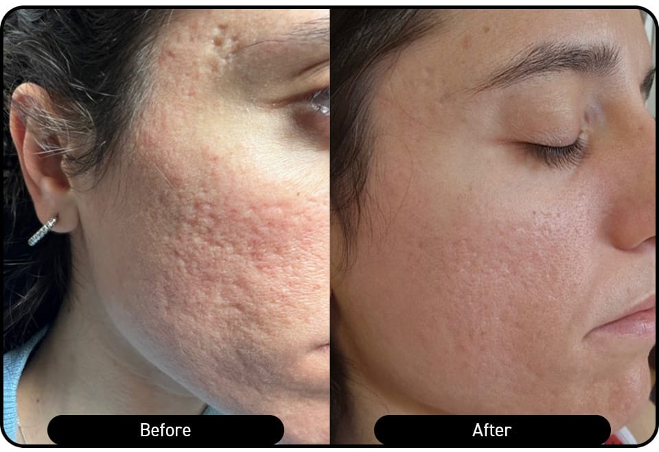 Facial rejuvenation after 2 Multifrax sessions - improved skin texture, tone, and reduced pigmentation