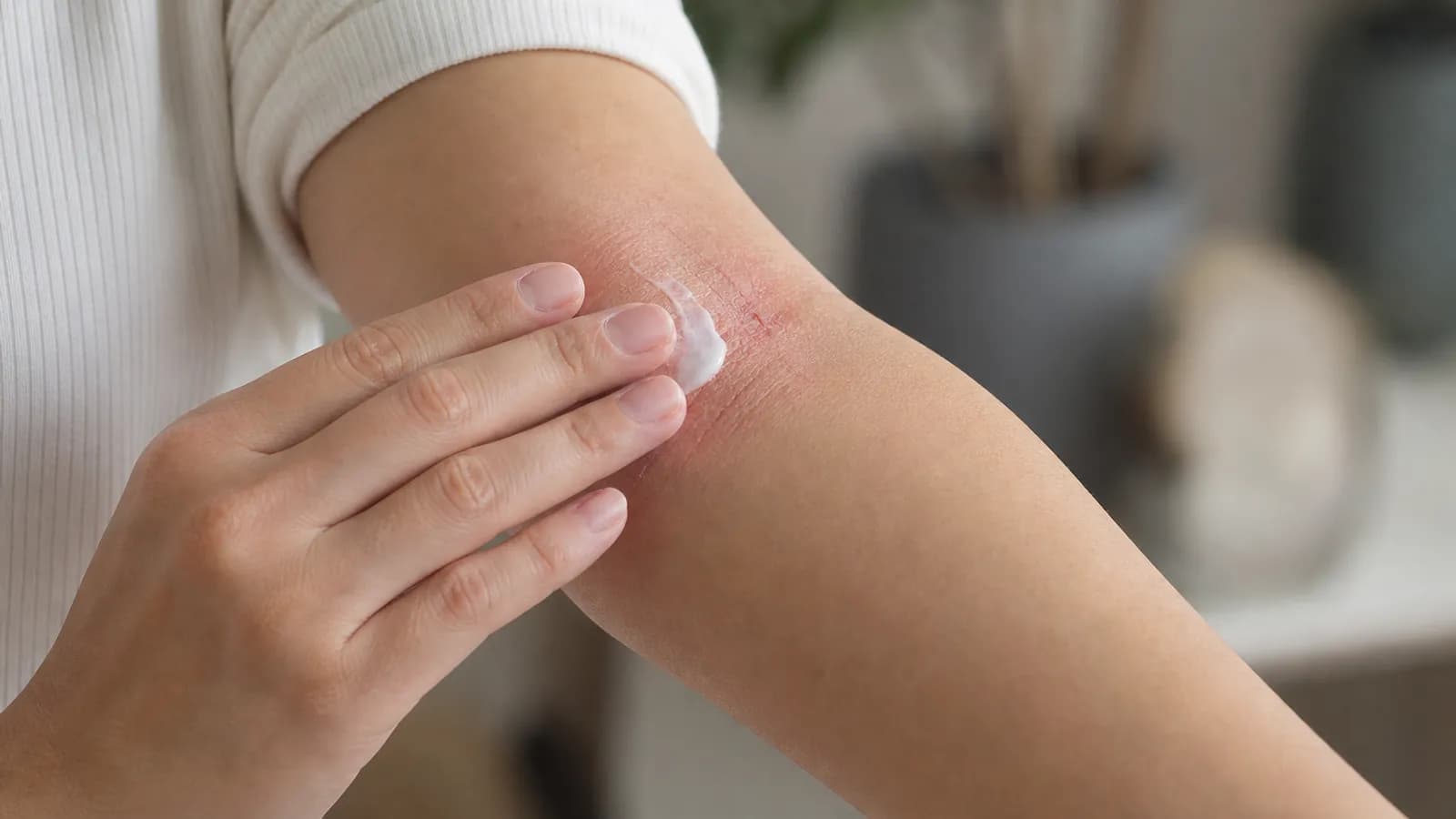 Moisturizer being applied to eczema-prone skin during a dermatology visit