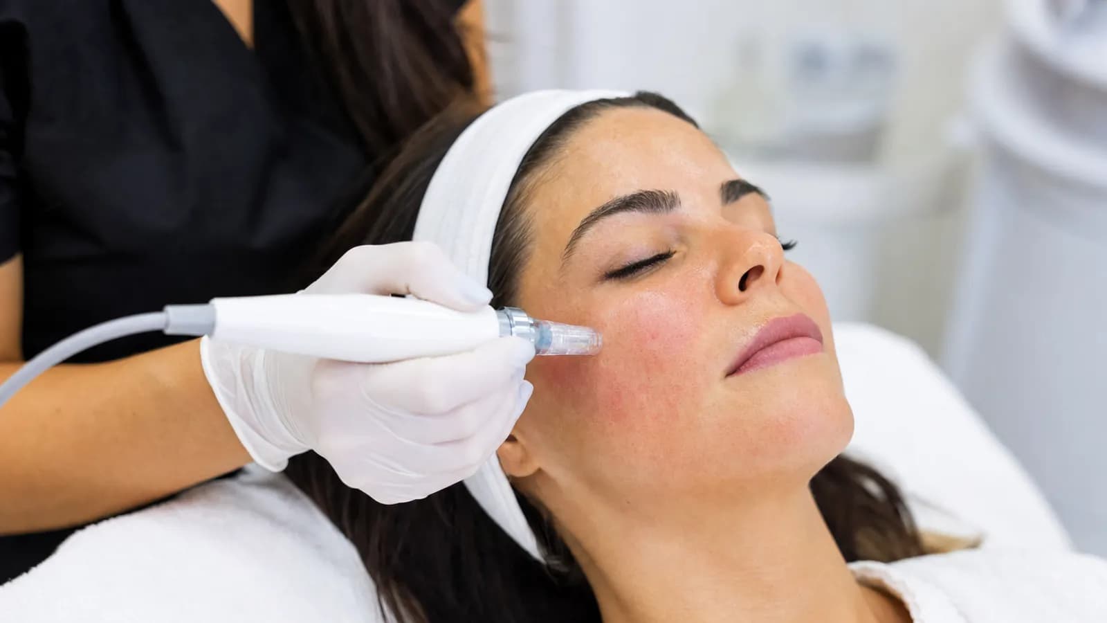 Microneedling treatment being performed on facial skin