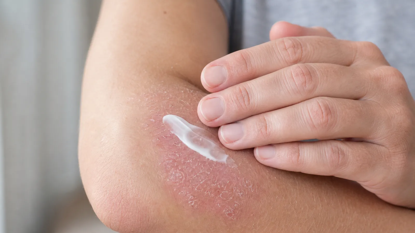 Dermatologist examining psoriasis plaques on a patient’s arm