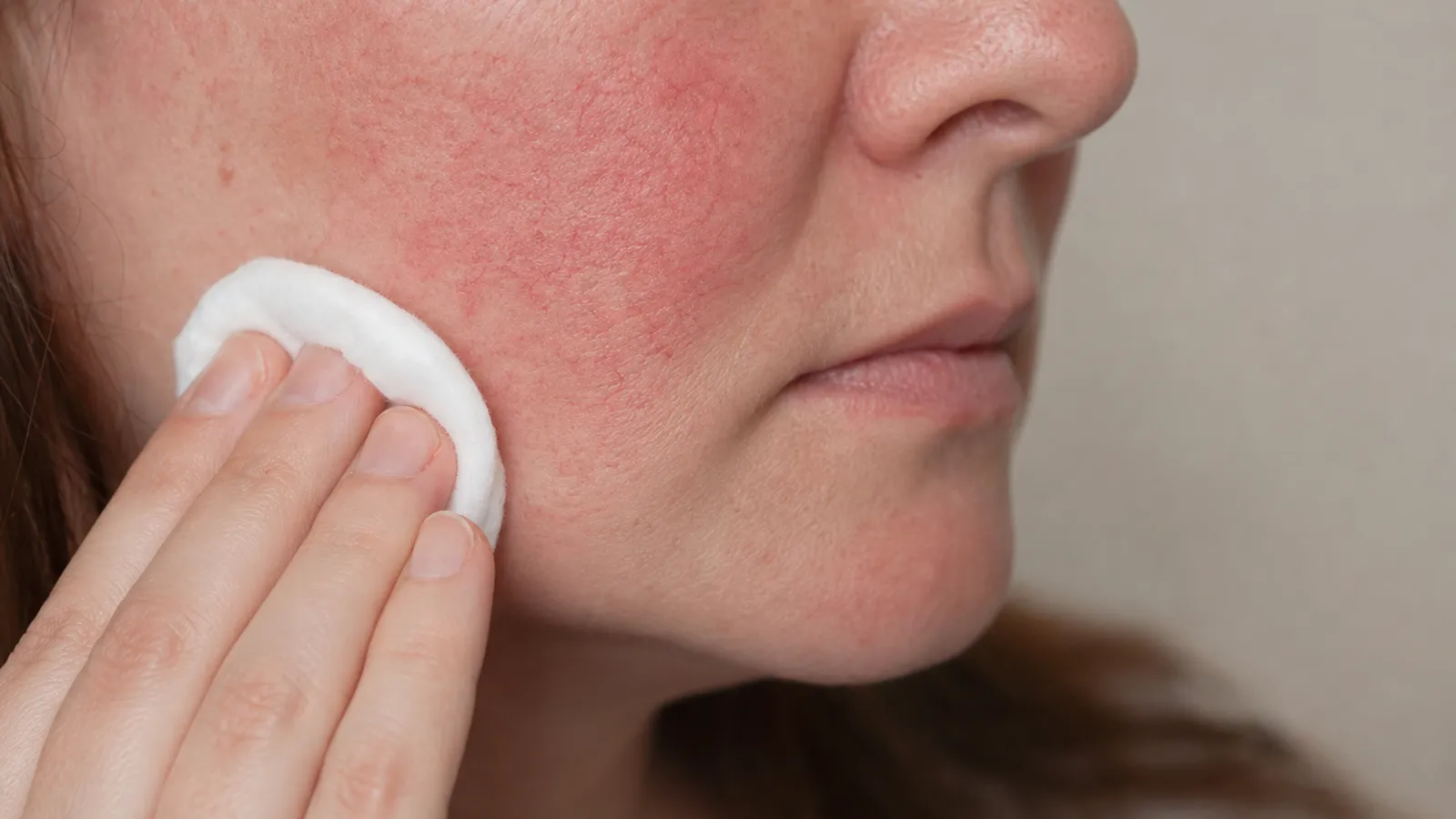 Gentle skincare treatment for rosacea-prone facial redness