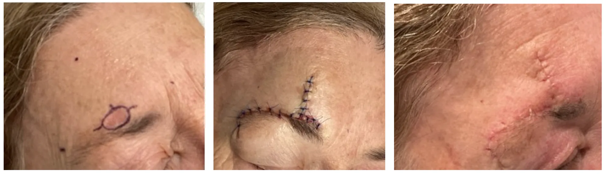 Case 10 — Pre-operative markings, post-operative closure, and healed result