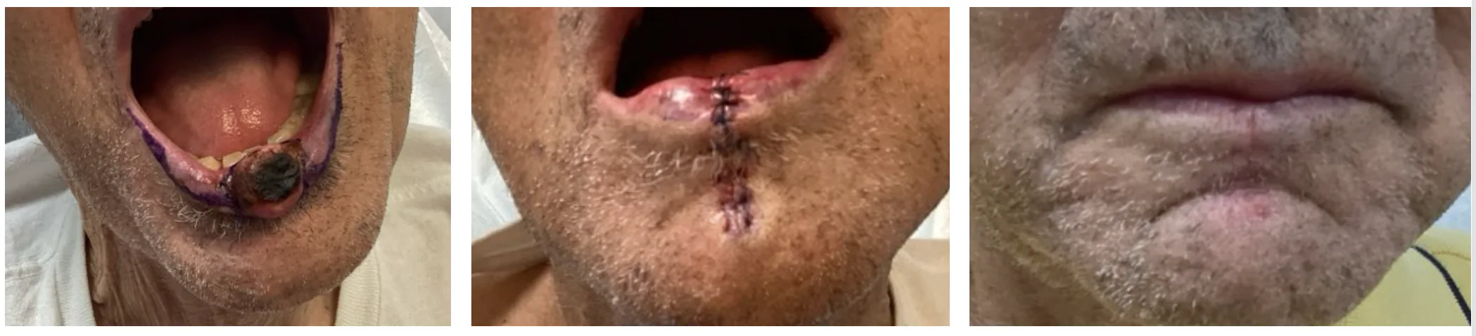 Case 2 — Pre-operative markings, post-operative closure, and healed result