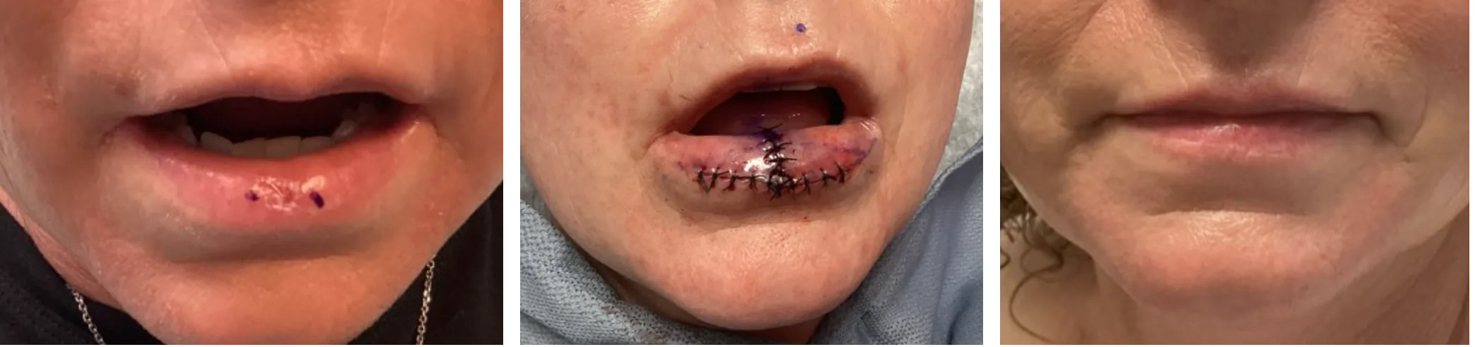 Case 3 — Pre-operative markings, post-operative closure, and healed result