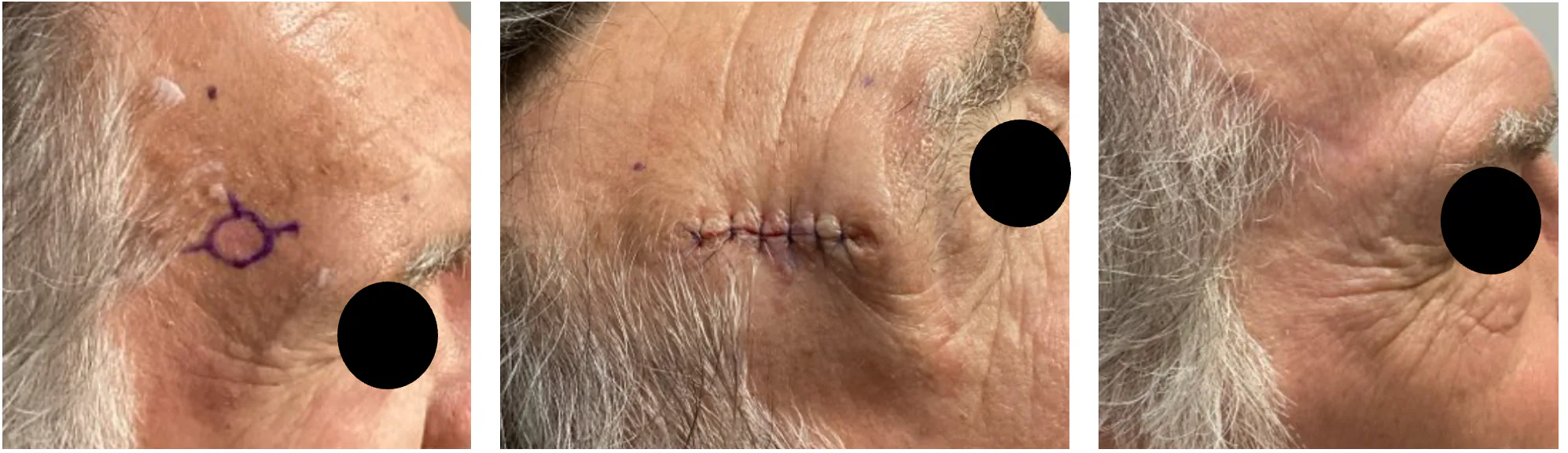 Case 4 — Pre-operative markings, post-operative closure, and healed result