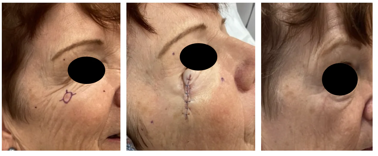 Case 5 — Pre-operative markings, post-operative closure, and healed result