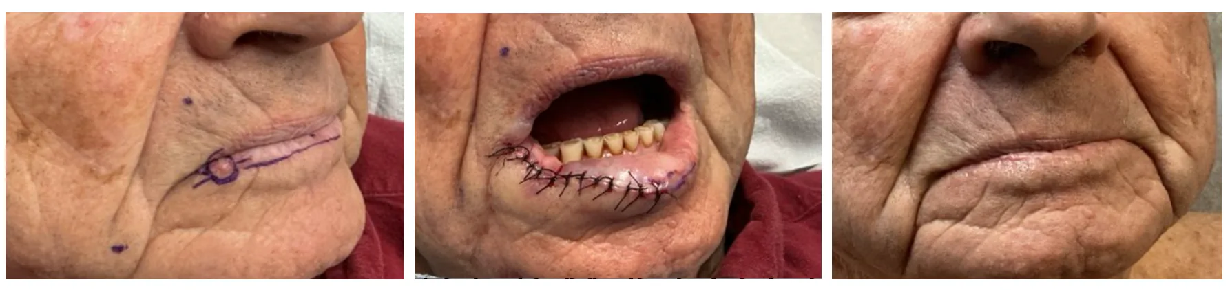 Case 6 — Pre-operative markings, post-operative closure, and healed result