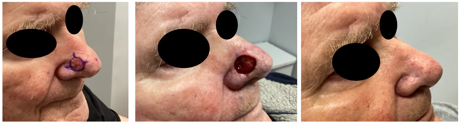Case 7 — Pre-operative markings, post-operative closure, and healed result