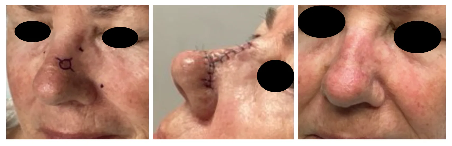 Case 8 — Pre-operative markings, post-operative closure, and healed result