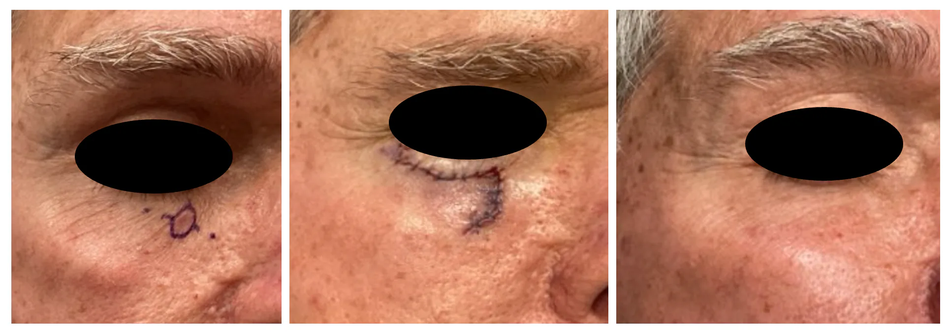 Case 9 — Pre-operative markings, post-operative closure, and healed result