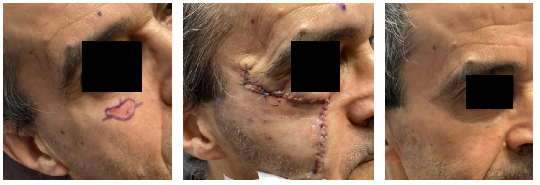 Case 1 — Pre-operative markings, post-operative closure, and healed result