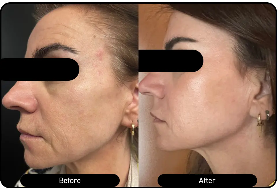 Skin transformation visible at 4 weeks post-treatment - continued collagen remodeling