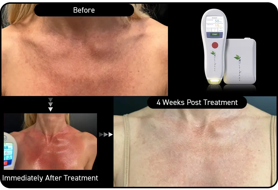Décolletage hyperpigmentation improvement after just 1 Multifrax treatment