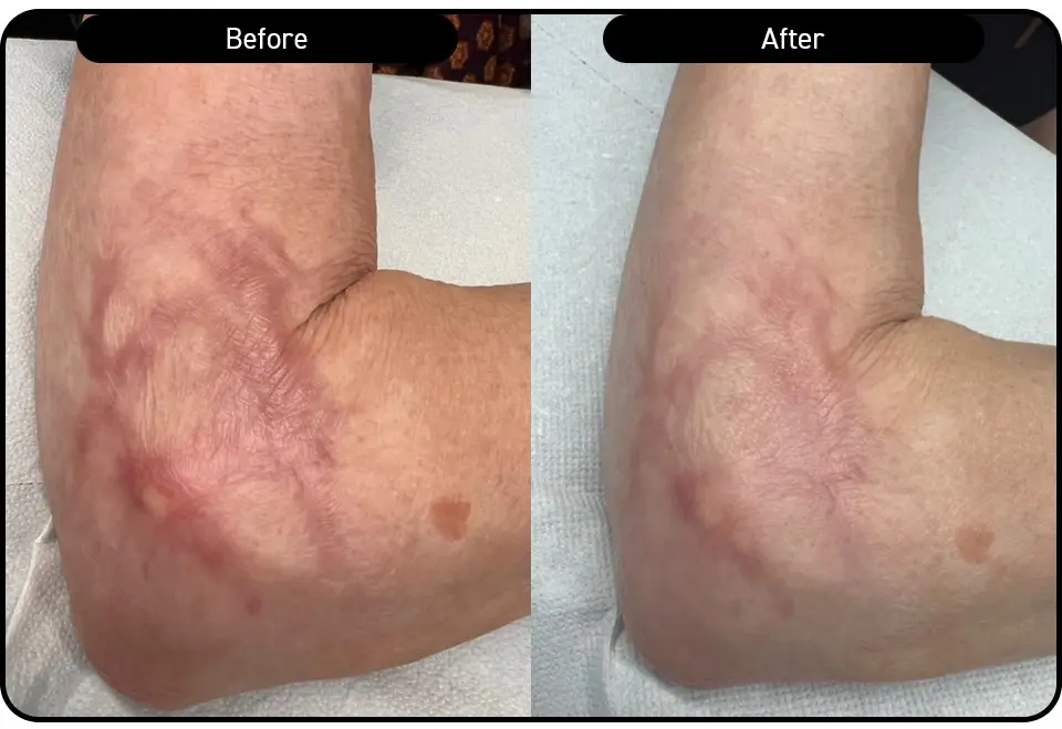 Elbow scarring reduction after 2 Multifrax treatments
