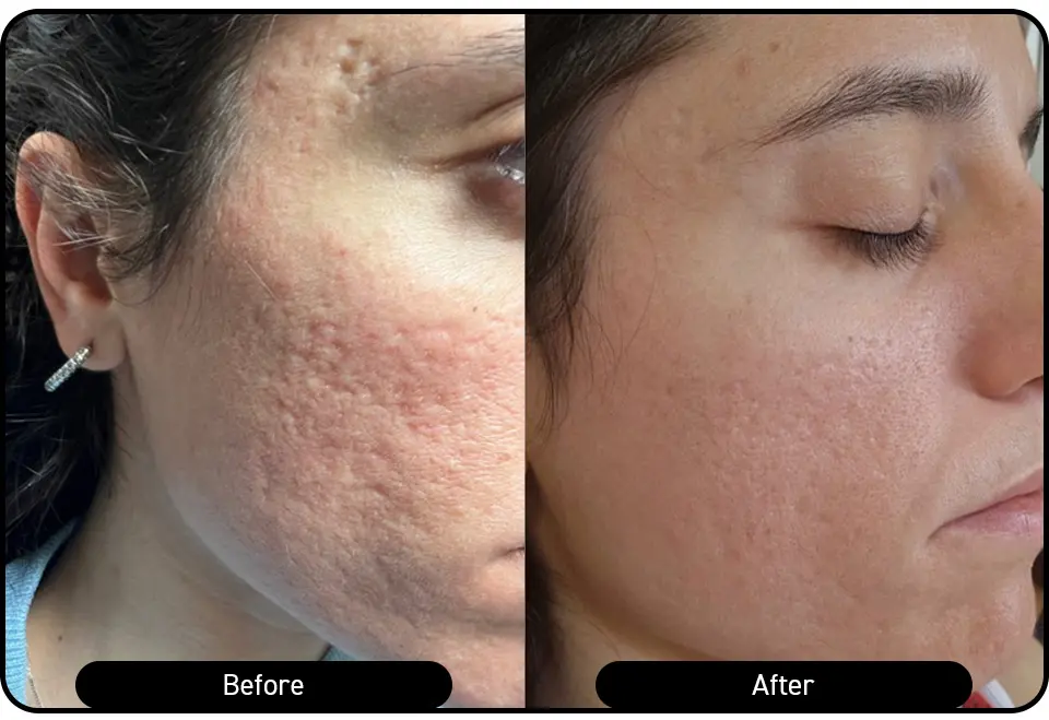 Facial rejuvenation after 2 Multifrax sessions - improved skin texture, tone, and reduced pigmentation